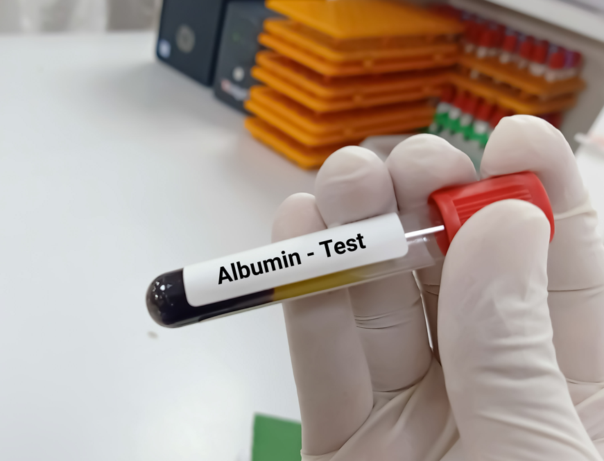 High Albumin Levels – Causes